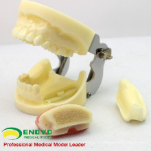 IMPLANT06 (12617) Modelo de mandíbula de implante com mandíbula inferior para aba e prática de perfuração